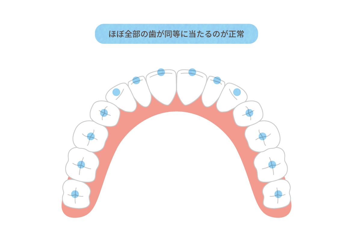 正しいかみ合わせ